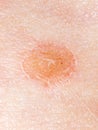 Ringworm on the human skin as a background