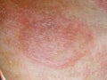 Ringworm red patches. Skin infection Royalty Free Stock Photo