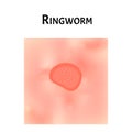 Ringworm on the skin. Vector illustration on isolated background Royalty Free Stock Photo