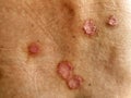 Ringworm (Tinea Corporis) on a human back, is a circular-shaped skin rash caused by a fungal infection Royalty Free Stock Photo