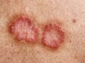 Ringworm (Tinea Corporis) on a human back, is a circular-shaped skin rash caused by a fungal infection Royalty Free Stock Photo