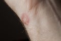 Ringworm on white man / Mycosis Royalty Free Stock Photo