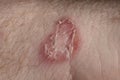 Ringworm on white man / Mycosis Royalty Free Stock Photo