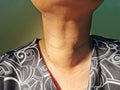 Anterior neck swelling or Goitre in elderly Asian lady