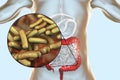 Rod-shaped bacteria Shigella which cause food-borne infection shigellosis or dysentery