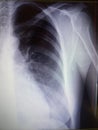 Roentgen photo of a lung after COVID 19 Royalty Free Stock Photo