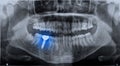 Roentgen teeth upper and lower jaw