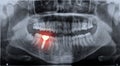 Roentgen teeth upper and lower jaw