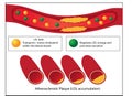 Role of good and bad lipids and levels of atherosclerotic plaque in blood vessel Royalty Free Stock Photo