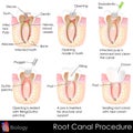 Root Canal Procedure Royalty Free Stock Photo