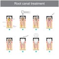 Root canal treatment. How to treat our teeth
