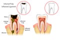 Root Canal Treatment. Infected Pulp and Inflamed Pulp