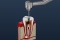Root canal treatment process. illustration