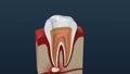 Root canal treatment process.