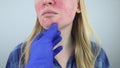 Rosacea face. The girl suffers from redness on her cheeks. Couperosis of the skin. Redness and capillary mesh are visible on the