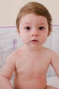 Roseola infantum Royalty Free Stock Photo