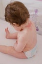 Roseola infantum Royalty Free Stock Photo