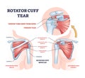 Rotator cuff tear as shoulder muscle trauma or arm injury outline diagram