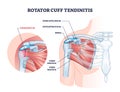 Rotator cuff tendinitis as shoulder muscular inflammation outline diagram Royalty Free Stock Photo