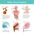 Rotavirus is transmitted by the accidental ingestion.it then da