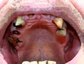 Rotten bad teeth. Caries. Periodontal disease. Dental.