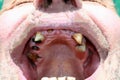 Rotten bad teeth. Caries. Periodontal disease. Dental.