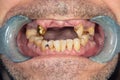 Rotten teeth, caries and plaque close-up in an asocially ill patient. The concept of poor hygiene and health problems