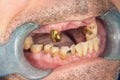 Rotten teeth, caries and plaque close-up in an asocially ill patient. The concept of poor hygiene and health problems