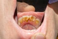 Rotten teeth, caries and plaque close-up an asocially ill patient. The concept of poor hygiene and health problems