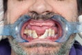 Rotten teeth during inspection with retractor for dental implant design