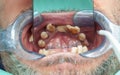 Rotten teeth during inspection with retractor for dental implant design