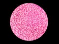 Rouleaux in blood smear. Red blood cell.