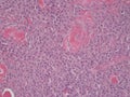 Histopathology ofRound Cell Tumor Royalty Free Stock Photo