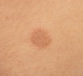 Round skin burns from hot oil