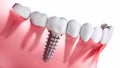 Closeup of dental implant in jaw