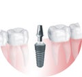 Dental implant and abutment