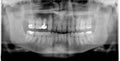 Rtg (x-ray) photo of man teeth