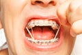 Rubber strings for teeth correction with braces