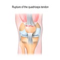 Rupture of the quadriceps tendon Royalty Free Stock Photo