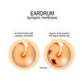 Ruptured perforated eardrum Royalty Free Stock Photo