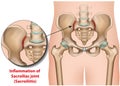 Sacroiliac joint inflammation 3d medical illustration sacroiliitis