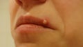 The sad mouth of a woman. A huge purulent pimple on the lip. A sickly look. Lips, mouth, a sad smile. An ugly sight.