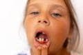 Sad, tired little girl pull off lip to show toothless mouth, fresh wound bleeding after tooth extraction. Dentist treat