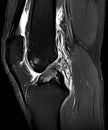 Sagital PD FS MRI of Knee