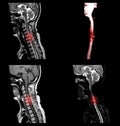 MRI C-spine or magnetic resonance image of cervical spine. Royalty Free Stock Photo