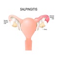 Salpingitis. inflammation in the Fallopian tubes.