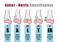 Salter - Harris classification to to recognize and identify different types of bone fractures