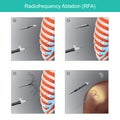 Radio frequency Ablation RFA. Illustration info graphic medical. Royalty Free Stock Photo