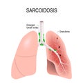 Sarcoidosis. Human`s lungs with granulomas Royalty Free Stock Photo