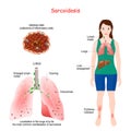 Sarcoidosis signs and symptoms. Development of granulomas